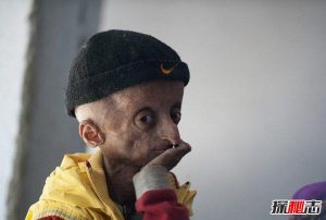 世界上十大必死病-